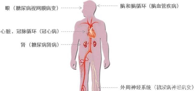 要来|糖尿病患者切莫麻痹大意,这个症状总出现,可能是并发症要来了