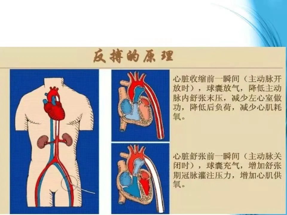 北京佑安医院|【佑安服务】首例IABP，北京佑安医院成功抢救心源性休克患者