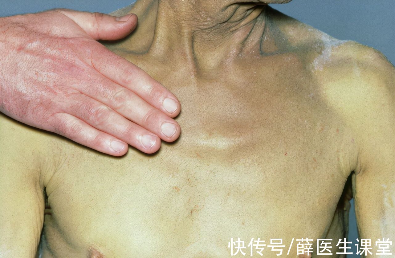 刘芬|32岁女白领，减肥成功，却因肝癌离世，可惜！怎能把“它”当饭吃