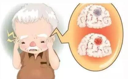 运动障碍|被称为“最快杀手”的脑出血，最怕3件事，高血压患者赶紧收藏