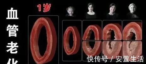 血栓|血管堵塞前已经给了你“4个信号”,不注意,中风的就是你自己!