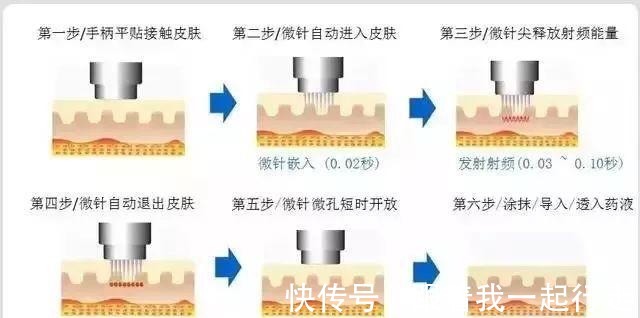 黄金微针 号称“小热玛吉”的黄金微针你了解吗！