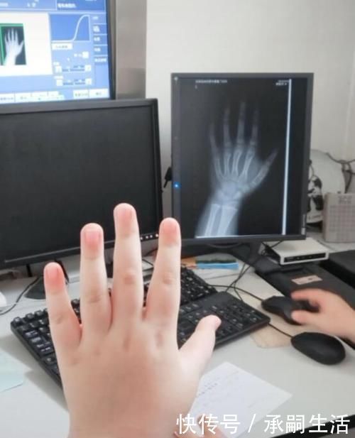 年龄|9岁娃骨龄已13岁,医生痛心斥责,父母干啥吃的还有父母不在意