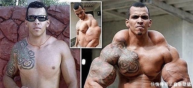 小伙子|还记得巴西那位向手臂注射燃油的小伙子吗 这是他3年后的样子