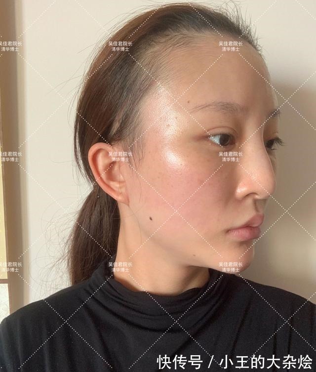 面部 做过3次线雕的她,为什么还要跑来做拉皮手术!