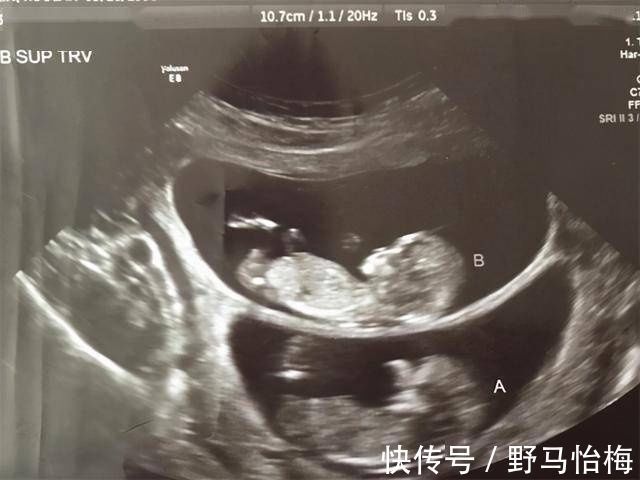 b超|孕妇做B超时,医生总是说胎儿比实际天数多几天是为什么?