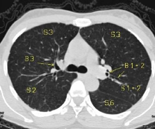 吸烟|得了肺结节到底意味着什么?肺结节用不用手术切除,医生这么说的