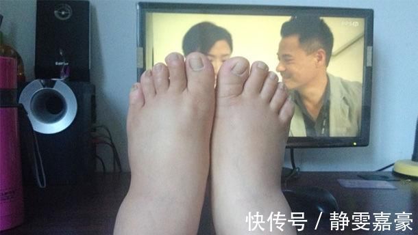 甲状腺功能减退|脚部有“4症状”,是“大病”在提前通知你,医生需尽早就医