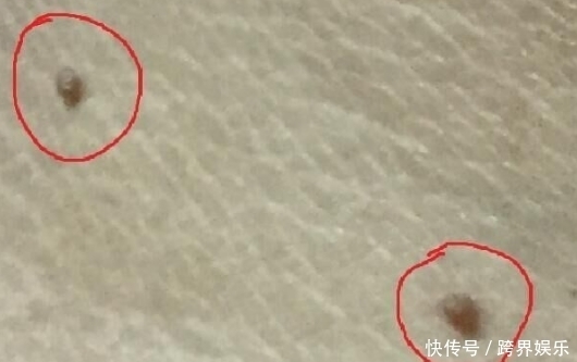  激素水平|脖子上的“小肉疙瘩”是什么？可能与3个原因有关