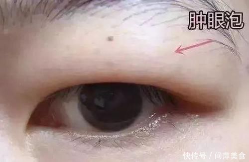 肿泡眼福音,到底怎么割,才不会出现肉条感