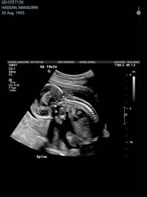 吗啡|震惊澳洲医院的一个操作,竟令婴儿胎死腹中!孕妇昏迷不醒!