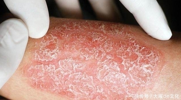 牛皮癣|经常喝“黄芪泡水”，或许会把4种病“挡在门外”，不妨一试