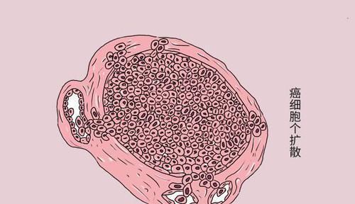 咽喉癌与咽喉炎,傻傻分不清?医生通俗教你区分方法,早知晓