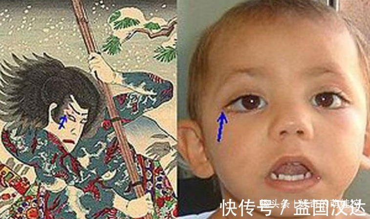 你好漂亮|有一种病叫“孩子太漂亮”,天生自带眼妆,是产检查不出的罕见病