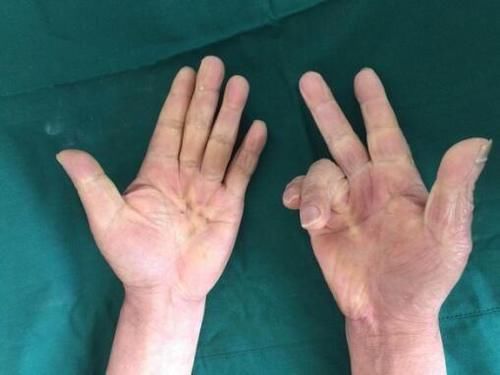 双手|血糖高不高,看双手就知道?如果出现这4种情况,建议注意起来