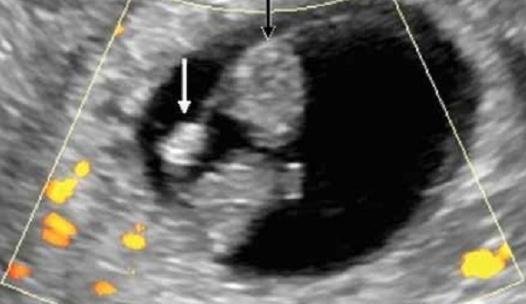什么是孕囊孕囊和卵黄囊有何区别 快资讯