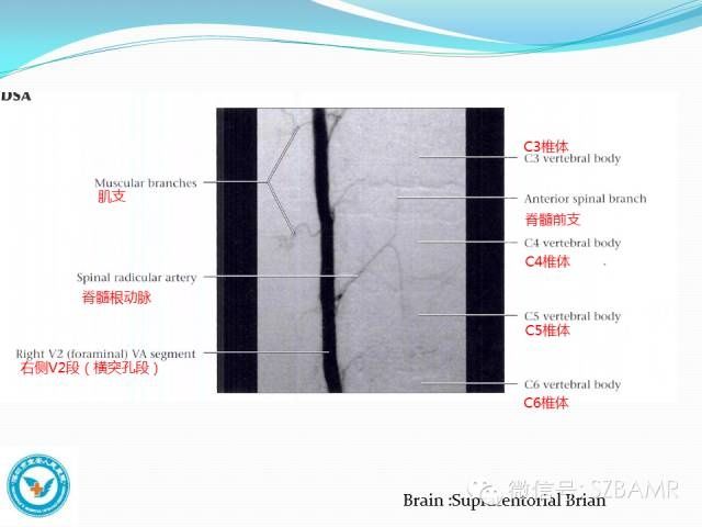 mr|椎-基底动脉系统解剖