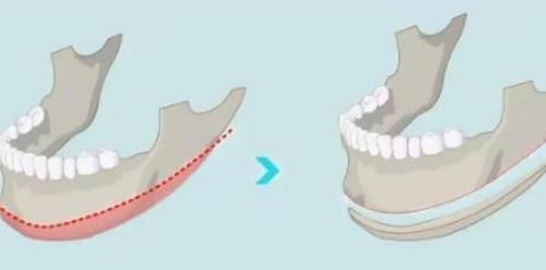 医院|25岁姑娘花3万多整容,却整成了十级伤残?医院:赔你5000元!