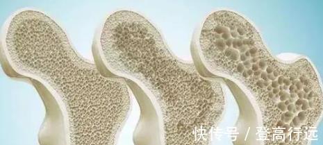 骨质疏松|茄子是骨质疏松的“发物”吗?想要养骨,这4种食物尽量远离