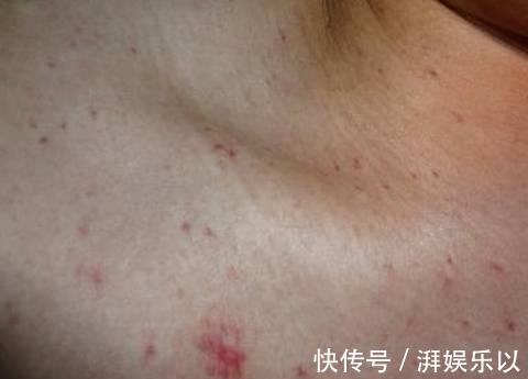 蜘蛛螨|45岁男子,不痛不痒,查出肝癌,提醒身体3处异常,及时检查