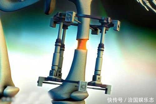 为了长高7厘米,花了16万去断骨增高的李亚诺,如今双腿彻底废了