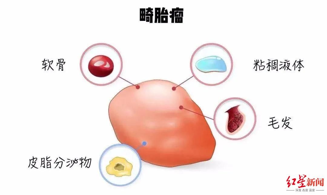 怀胎|男子“怀胎”45年，医生手术取出5斤重畸胎瘤