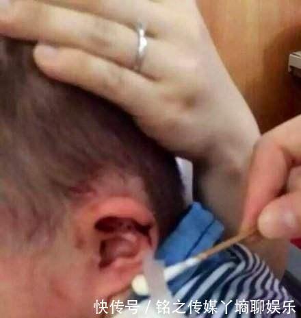 小凌|7岁男童总说耳朵痒,妈妈用手电筒一看,身上的鸡皮疙瘩都起来了
