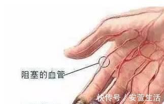 血栓|血管堵塞前已经给了你“4个信号”,不注意,中风的就是你自己!