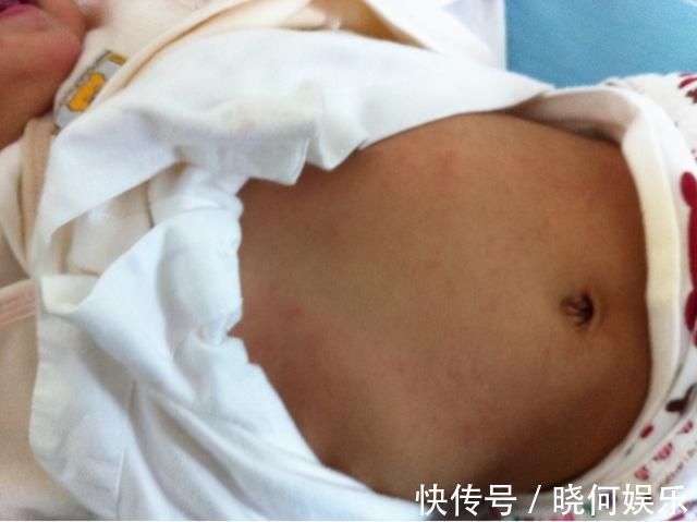 育儿百科|6个月后宝宝第一次发烧,多是幼儿急疹,烧退疹出,免疫力升级2.0