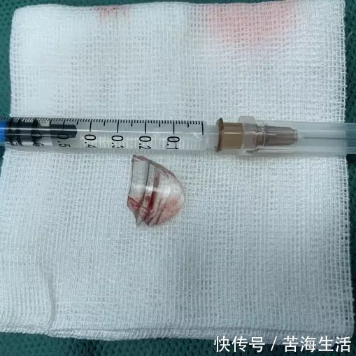 硬币|食管被烧黑!2岁娃来深紧急手术,只因吃下这东西!家里太常见