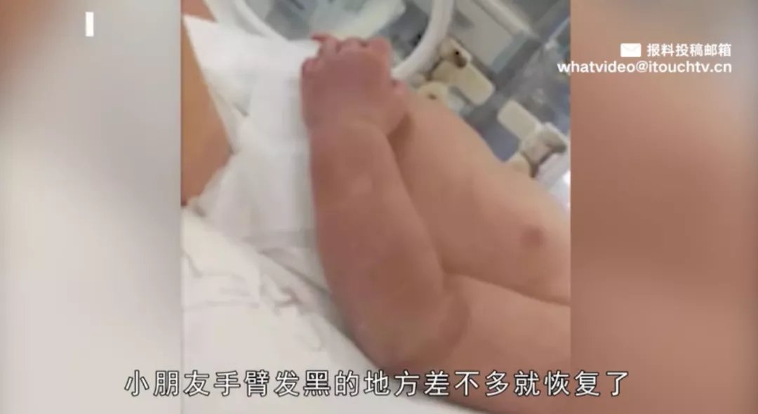 橡皮筋|触目惊心！刚出生1天的宝宝险被截肢，只因妈妈一个疏忽…