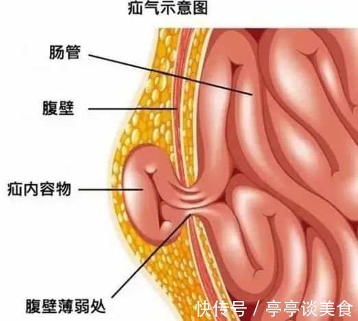 龚渭华|27岁小伙拉黑便查出这种癌症！家人却选择了放弃治疗…