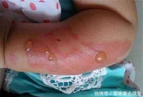 医生|6岁儿子被100度开水烫伤,宝妈“2招”救了娃,医生:很优秀