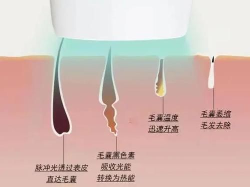 深扒！脱毛仪是智商税吗？