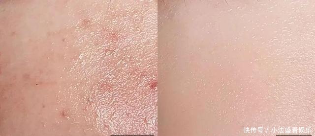 别人刷酸是蛋壳肌,你刷酸就烂脸?原因其实在这里