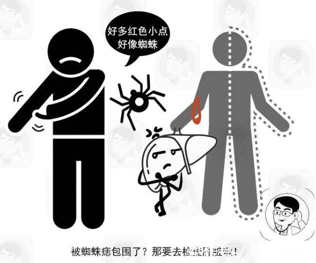 病毒性肝炎|身体这6个标志,或是肝硬化的信号,有3个以上,提示肝病在恶化