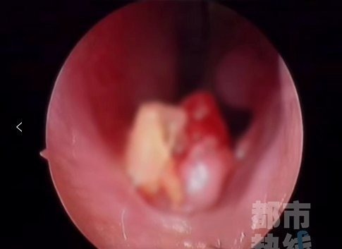 失踪|一6岁女童鼻子里“长牙”,取出后发现竟是三年前失踪的门牙