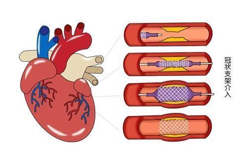 身体不适|心脏放了支架,还能活多久?能长寿吗?医生不隐瞒,坦诚说出答案