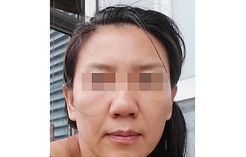 做超微创小切口提升手术，我的顾虑和感受