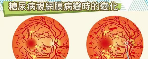 生活方式|从起病到死亡，得了糖尿病是怎样一种体验？