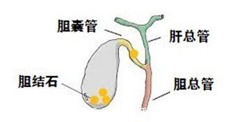 胆结石|鸡蛋吃多了会得胆囊结石？一天最多吃几个？注意，这类人不适合吃……