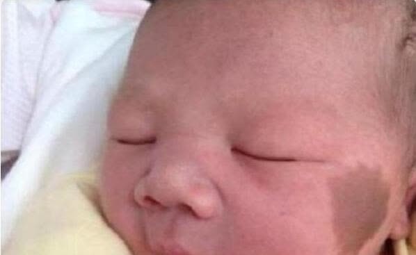 胎记|宝宝的胎记怎么来的?产科医生:孕期这2种行为易长胎记,要避开