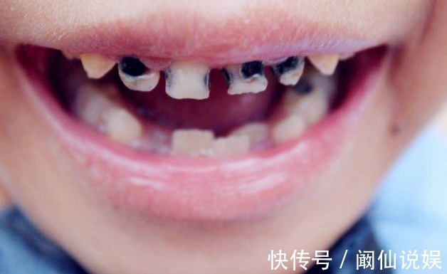 满口|造成孩子“满口黑牙”的并不是糖果,而是家里这3样东西,你有吗