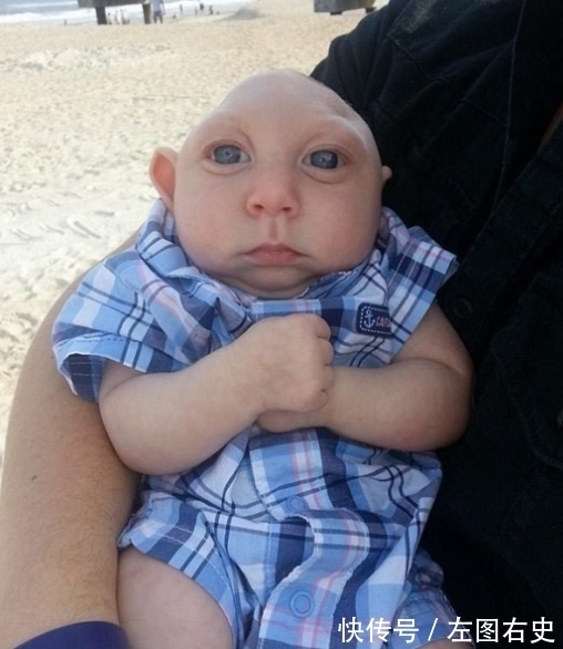 畸形儿|小男孩出生只有“半个脑袋”,好像被削去了,医生:活不过3个月