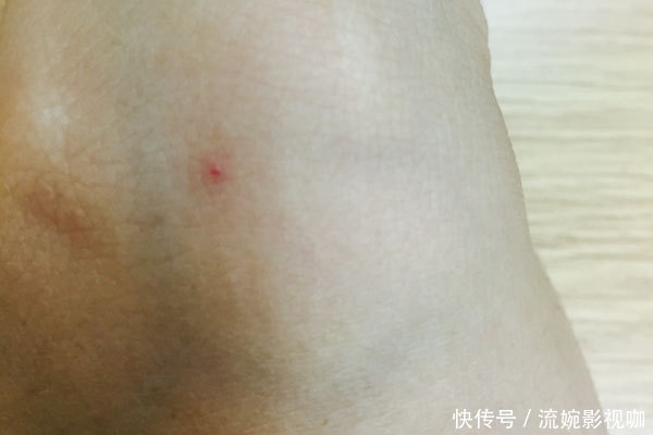 老年斑|为什么人到了一定年纪,身上会出现小红痣?为了健康,多了解一下