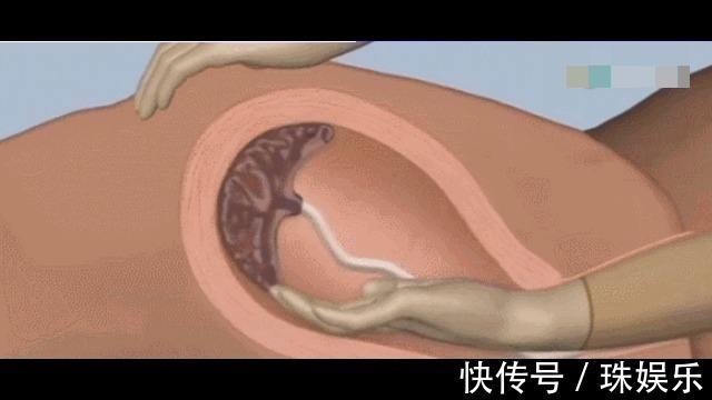 宫缩|为什么有些产妇生完孩子后,胎盘不能自动娩出,还需要手剥胎盘