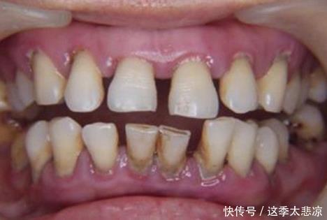 健康|人人都想要拥有一口好牙,牙缝变大,多半是这样原因引起的