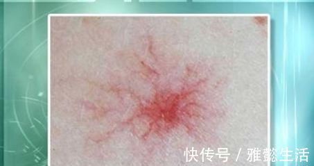 肝硬化患者|肝硬化患者，身体如果没有3个“症状”，恭喜，证明肝脏在好转