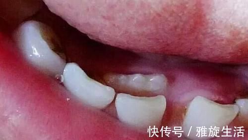 孩子|孩子“乳牙”脱落别着急扔,关键时刻能救命不懂为啥尽快了解下