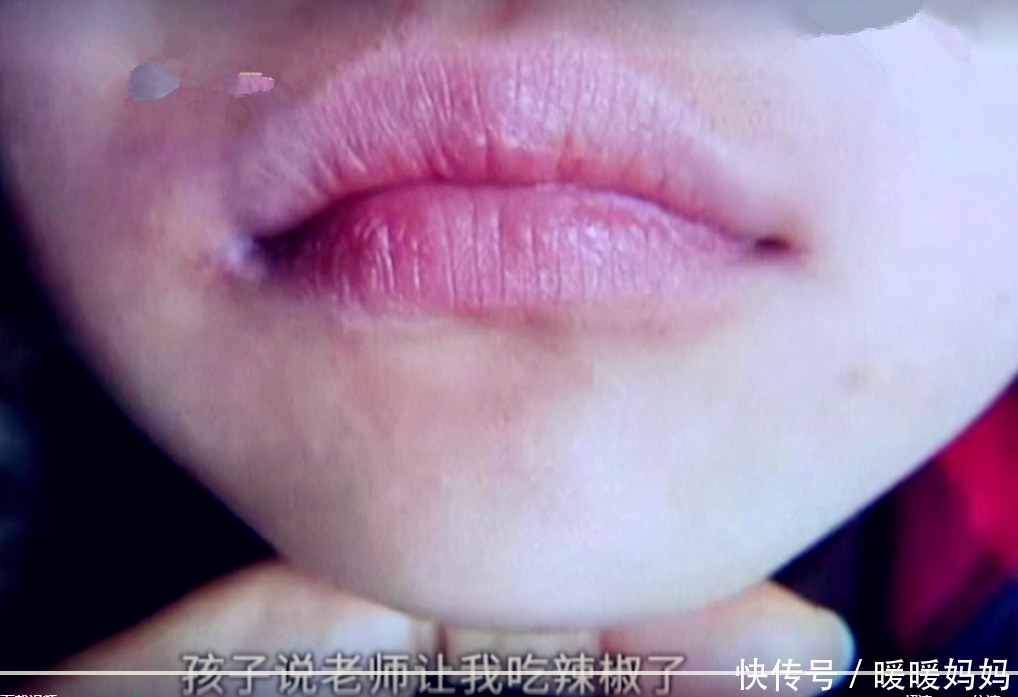 嘴巴|孩子不吃饭被老师“灌辣椒”,嘴巴红又肿,看完监控妈妈愤怒不已